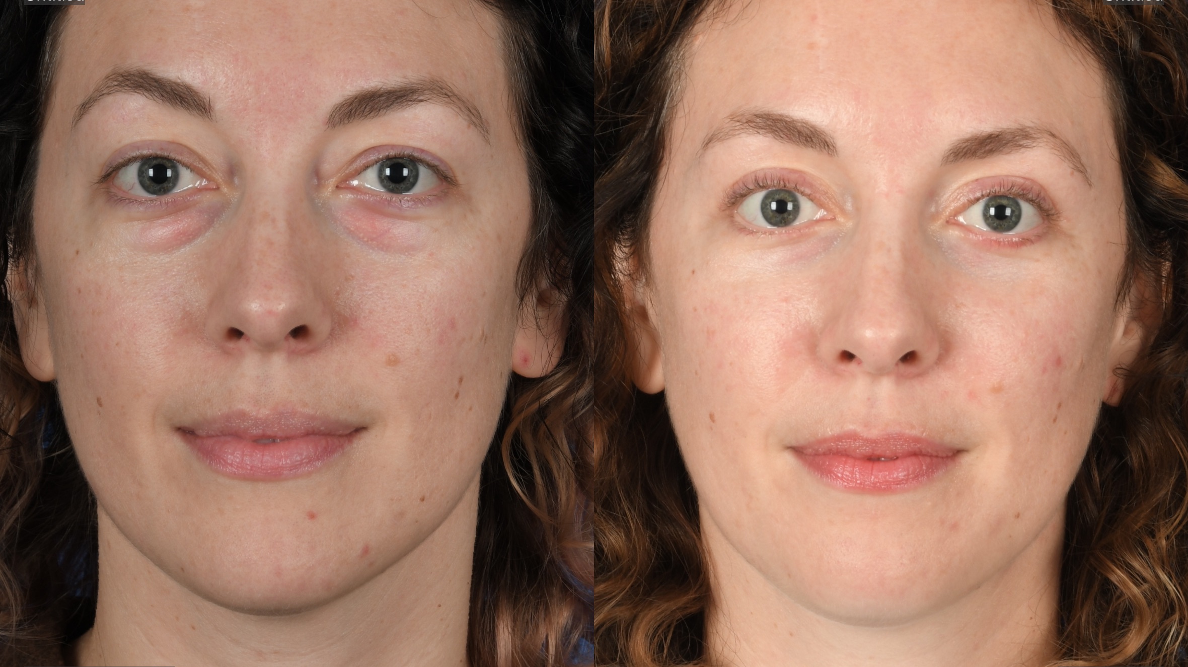 Before and After Image: Upper and Lower Blepharoplasty - front