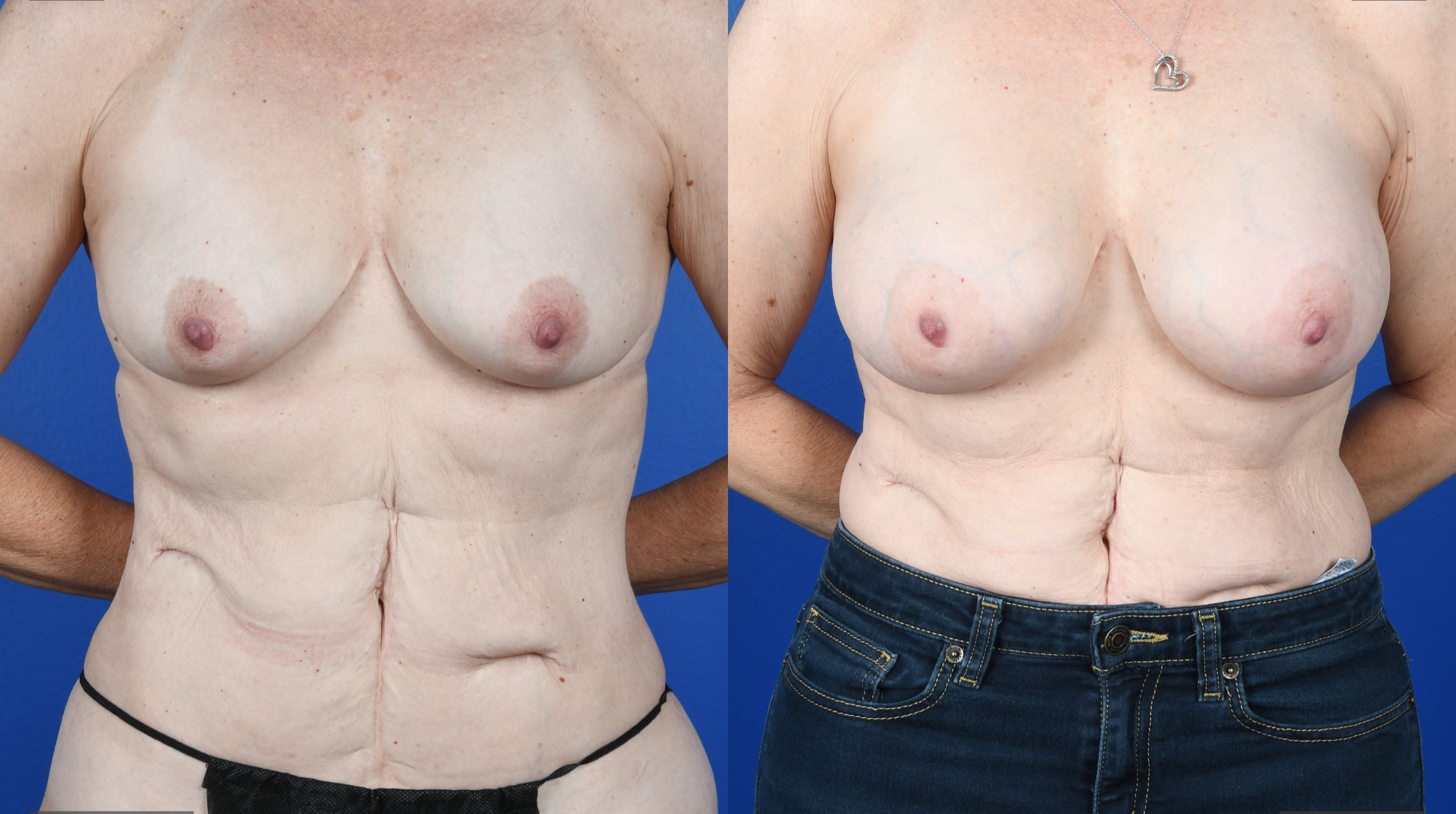 Before and After Image: Breast Augmentation – Silicone - front
