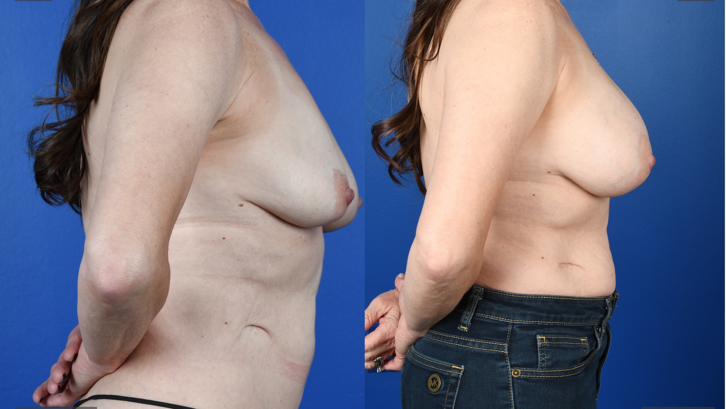 Before and After Image: Breast Augmentation – Silicone - right-side