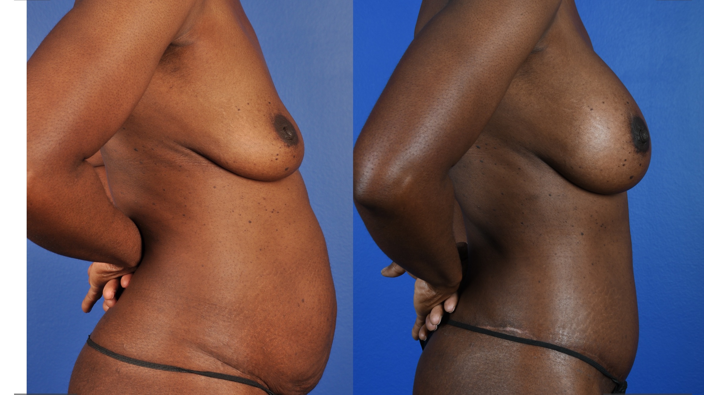 Before and After Image: Abdominoplasty – Extended, Breast Augmentation – Silicone - right-side