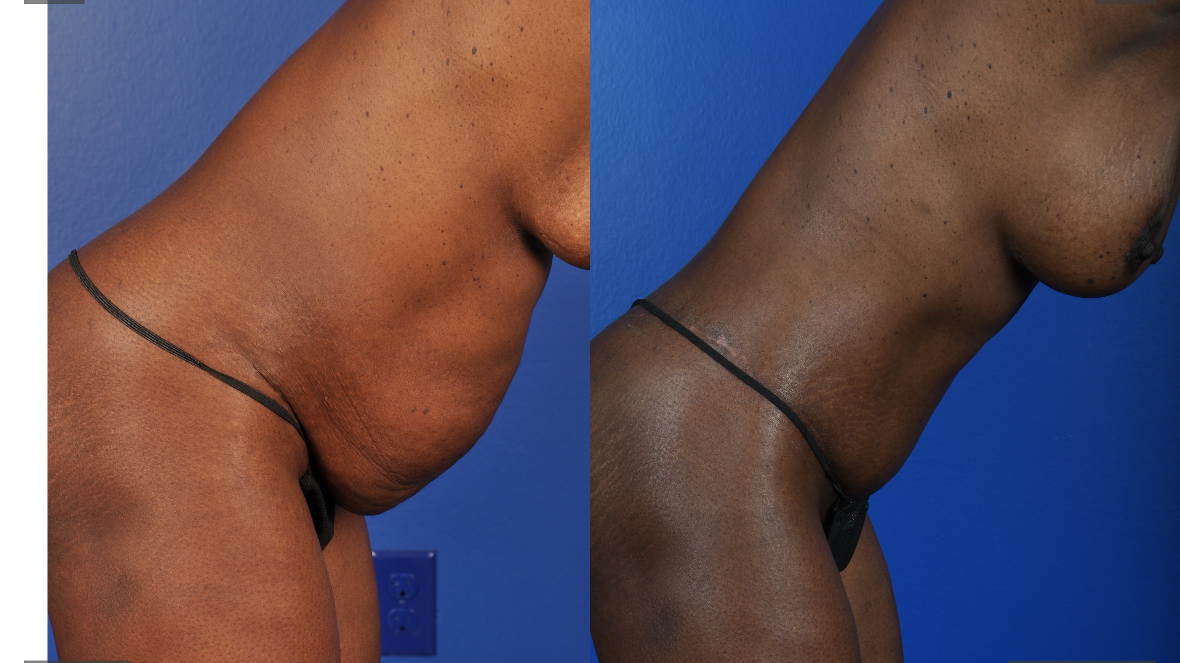 Before and After Image: Abdominoplasty – Extended, Breast Augmentation – Silicone - other