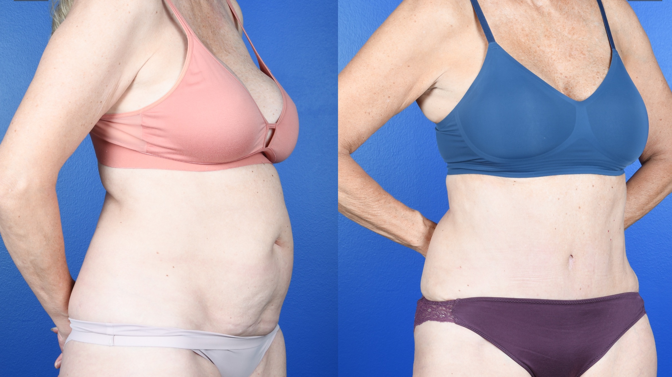 Before and After Image: Abdominoplasty - right-front-oblique
