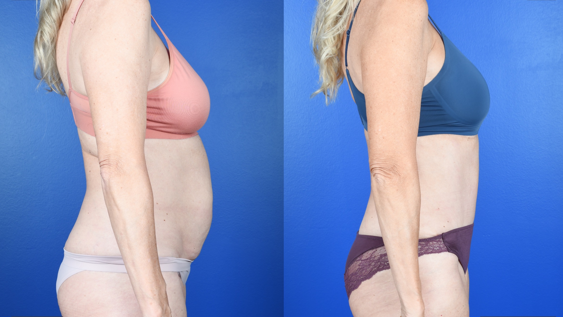 Before and After Image: Abdominoplasty - right-side