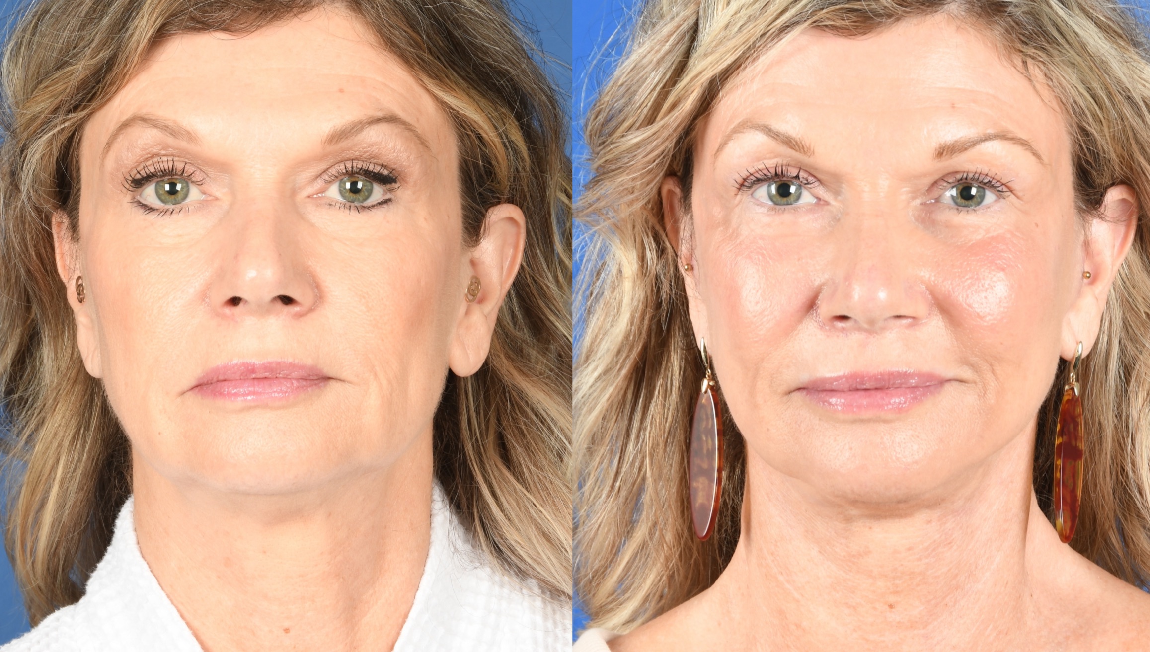 Before and After Image: Facelift, Full Face Laser - front