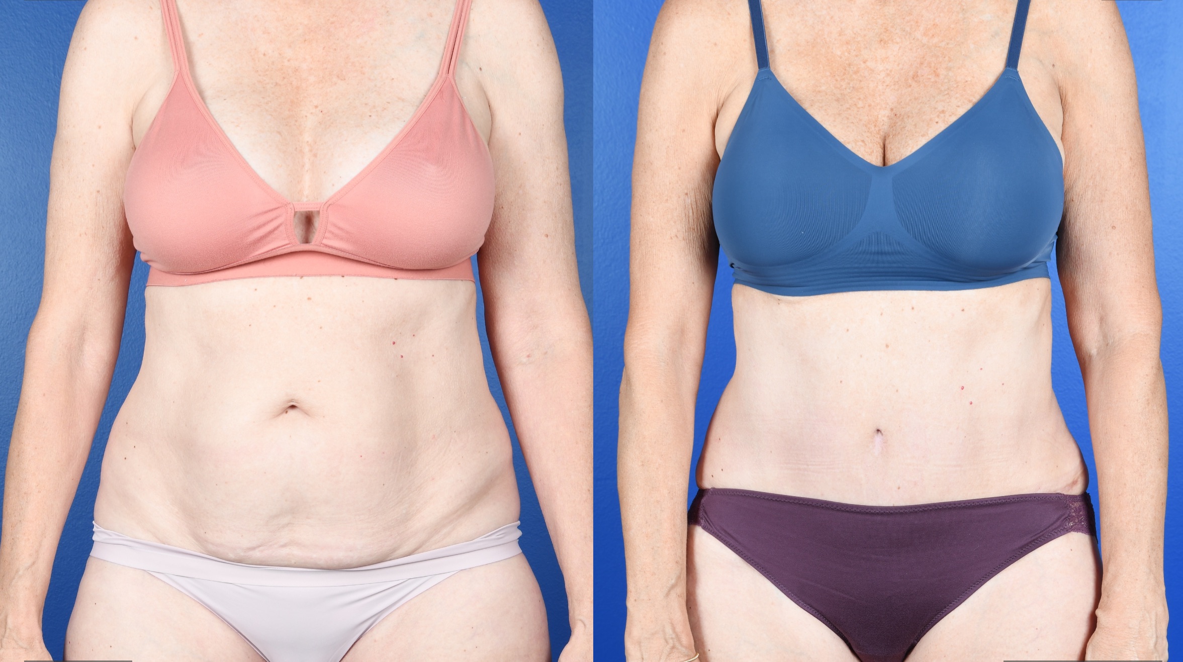 Before and After Image: Abdominoplasty - front