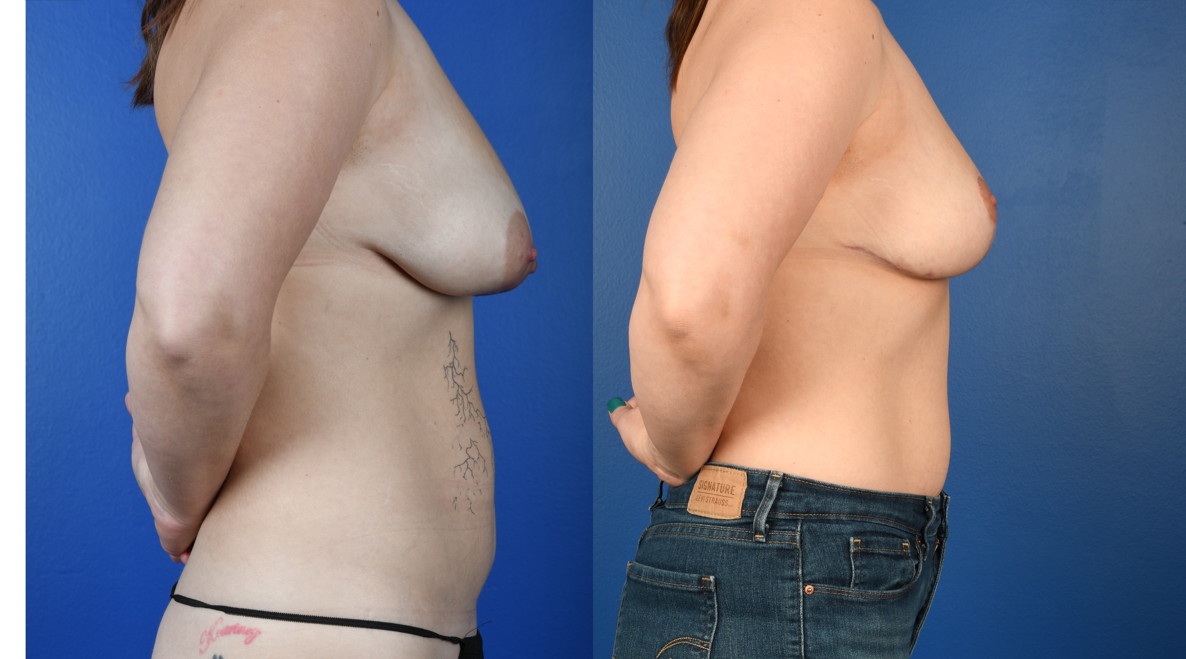 Before and After Image: Mastopexy - right-side