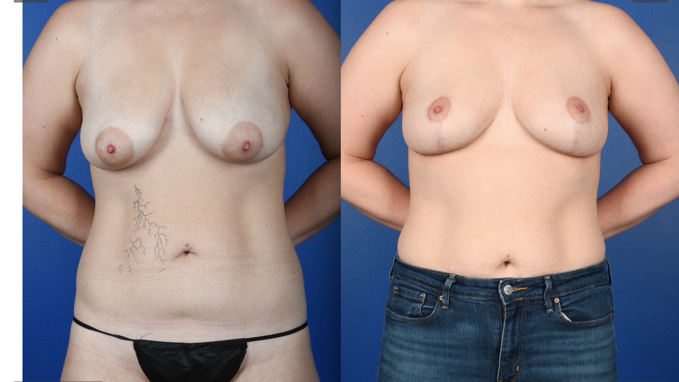 Before and After Image: Mastopexy - front