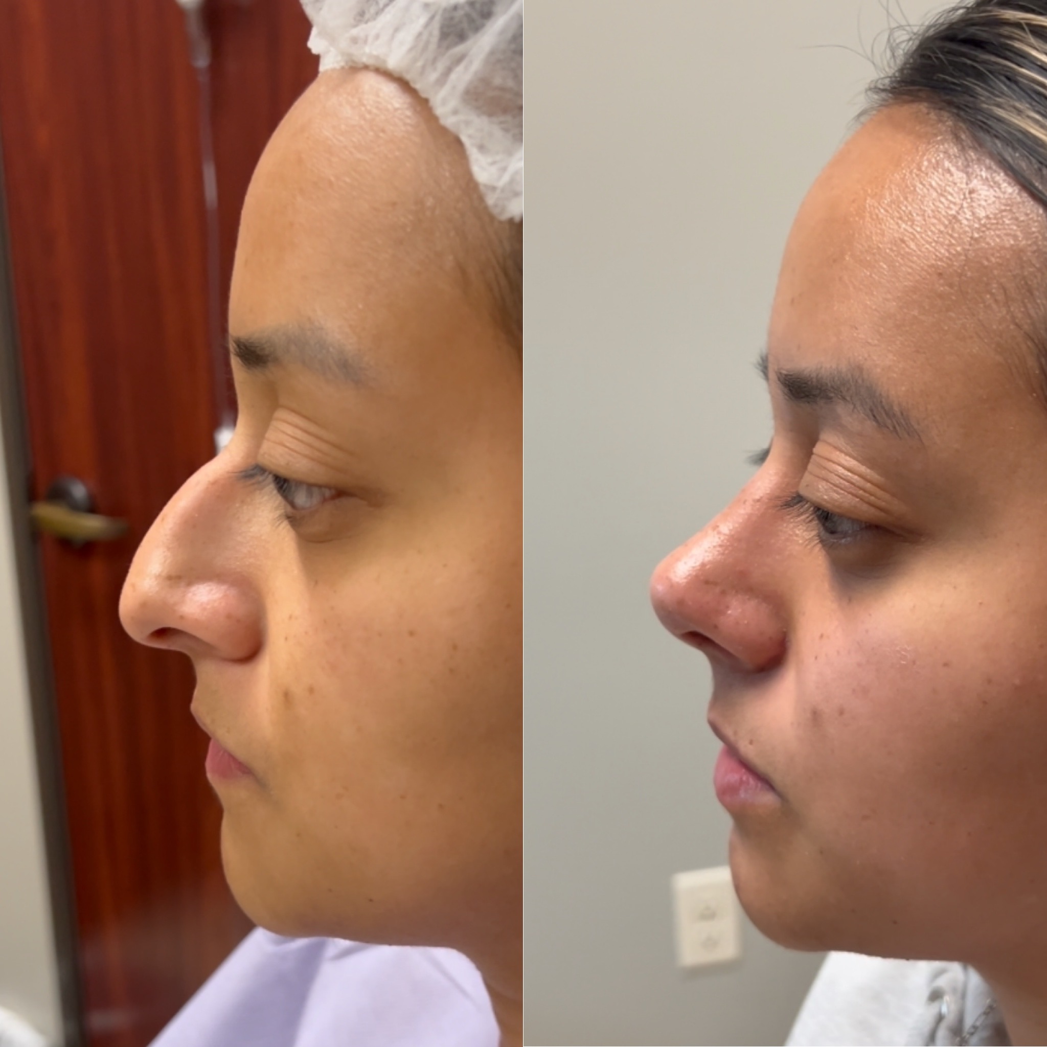 Before and After Image: Primary Rhinoplasty - left-side