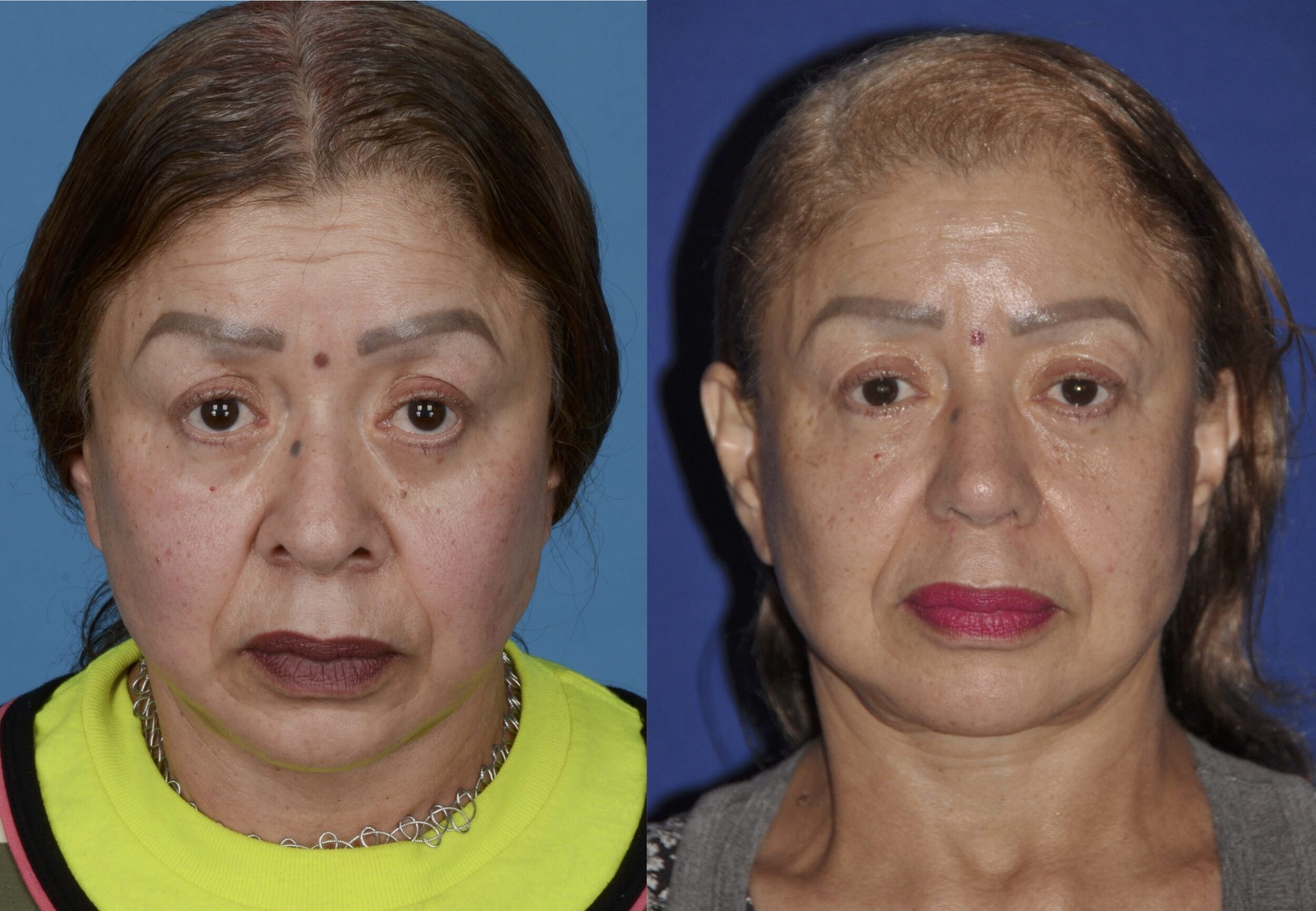 Before and After Image: Precision Rhinoplasty - front