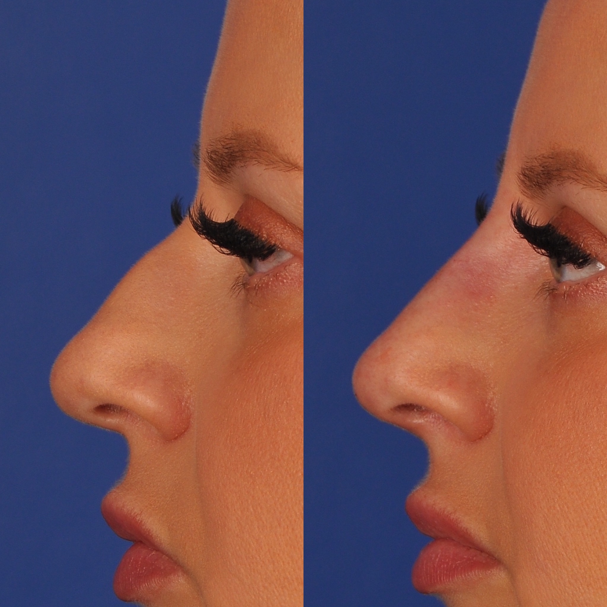 Before and After Image: Liquid Rhinoplasty - left-side