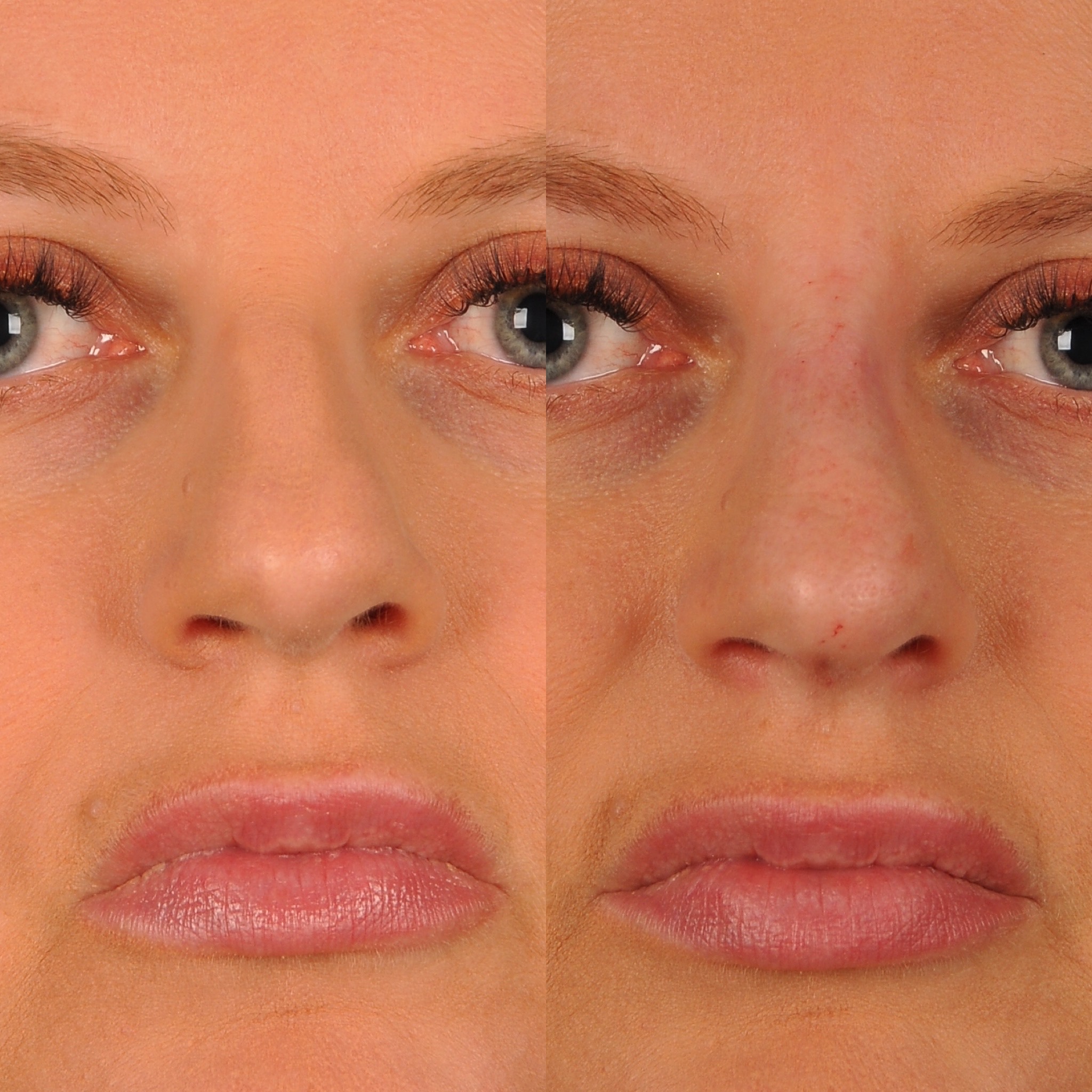Before and After Image: Liquid Rhinoplasty - front