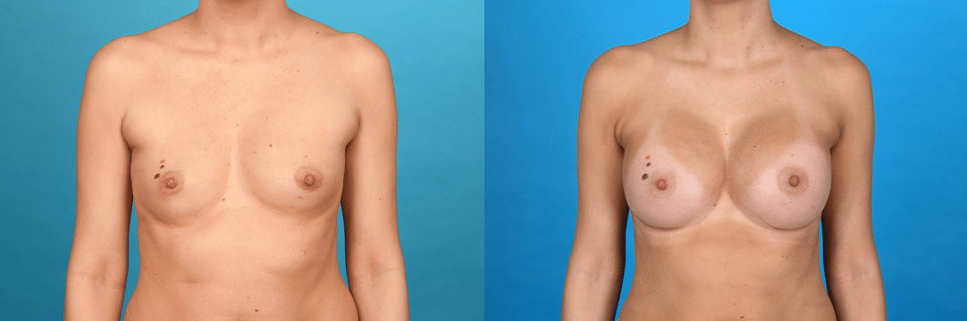 Before and After Image: Breast Augmentation - front
