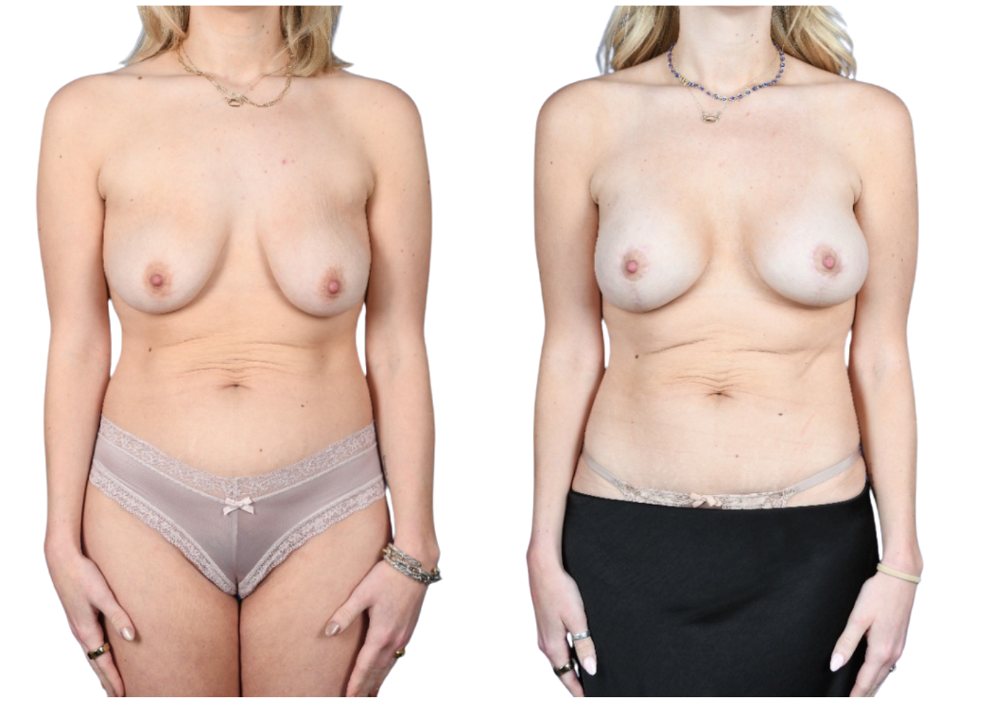 Before and After Image: Mastopexy, Breast Augmentation - front