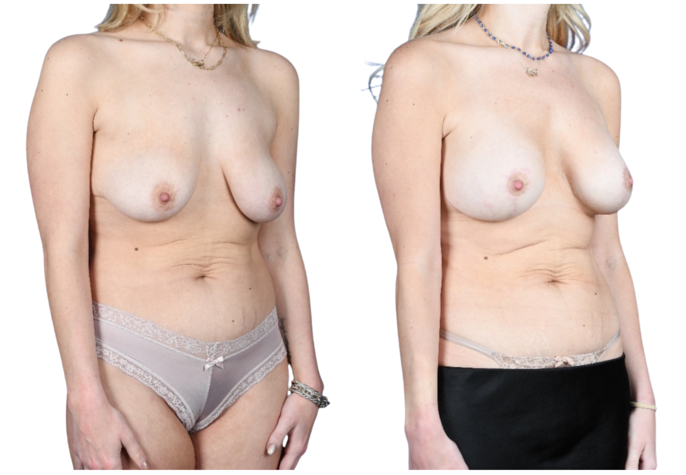 Before and After Image: Mastopexy, Breast Augmentation - right-front-oblique