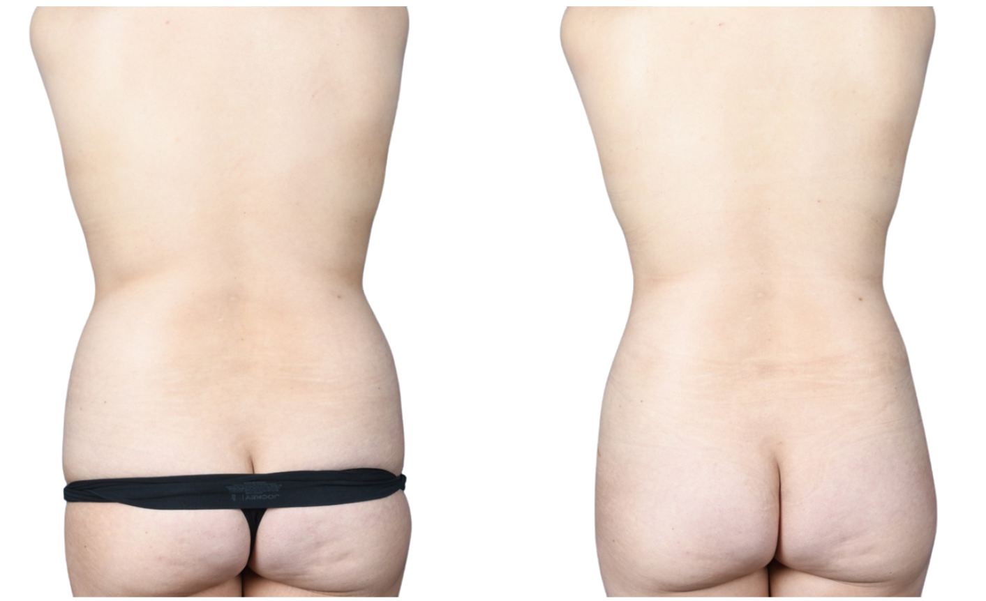 Before and After Image: Extended Abdominoplasty (Supine Lipo), Breast Augmentation - back