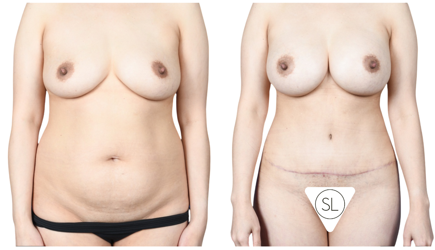Before and After Image: Extended Abdominoplasty (Supine Lipo), Breast Augmentation - front