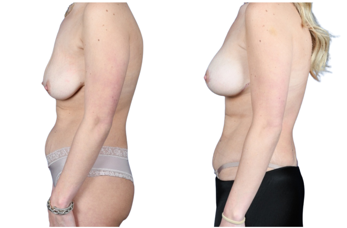Before and After Image: Mastopexy, Breast Augmentation - left-side