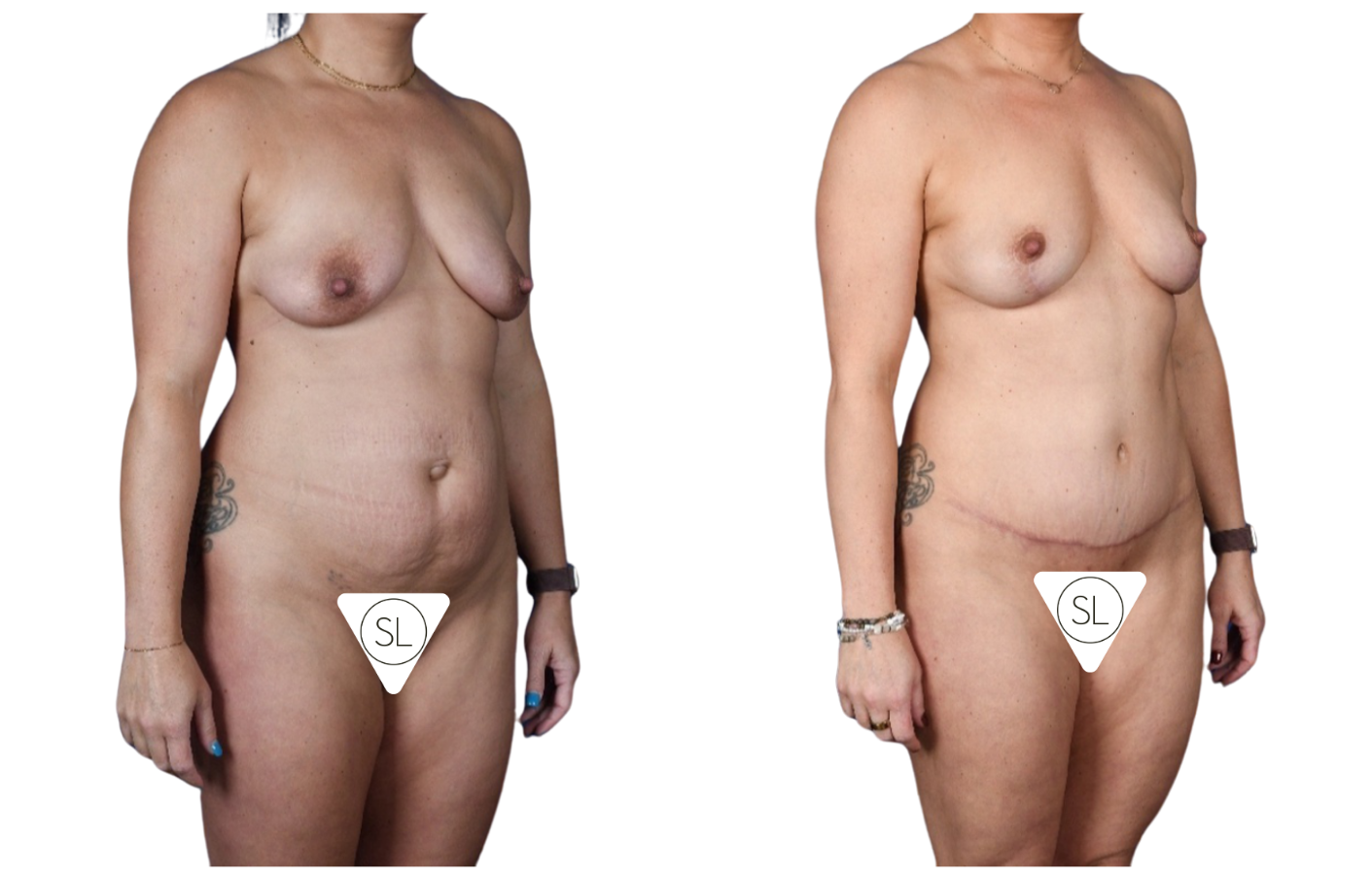 Before and After Image: Breast Fat Grafting, Abdominoplasty, Liposuction Flanks - right-front-oblique