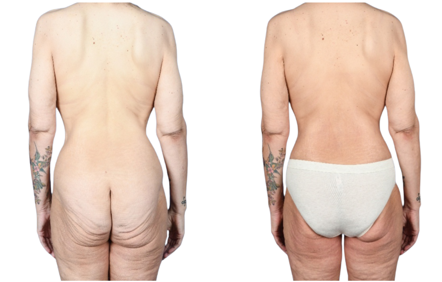 Before and After Image: Abdominoplasty, Mastopexy, Breast Augmentation, Mesh Implant Support - back