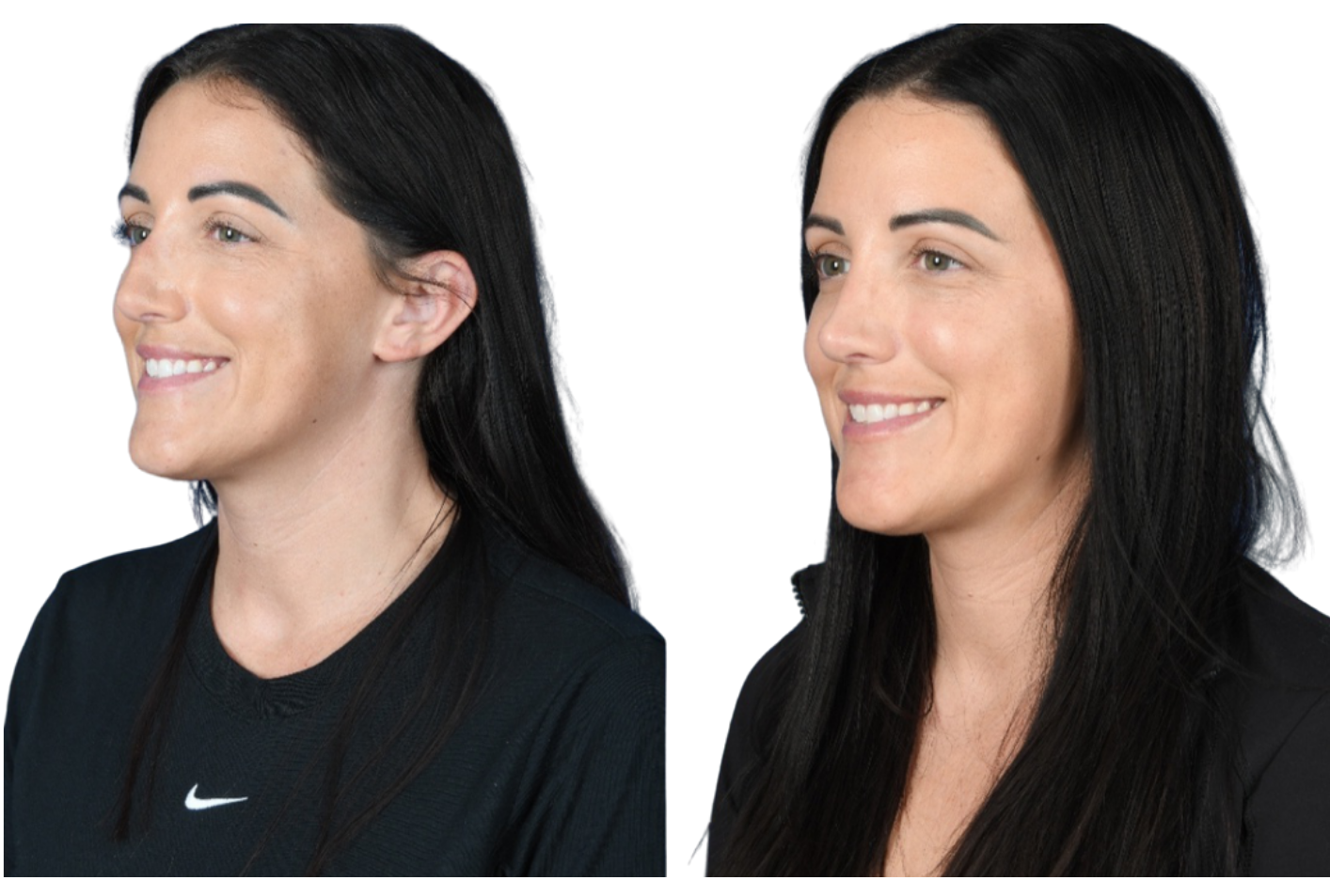 Before and After Image: Rhinoplasty - left-front-oblique