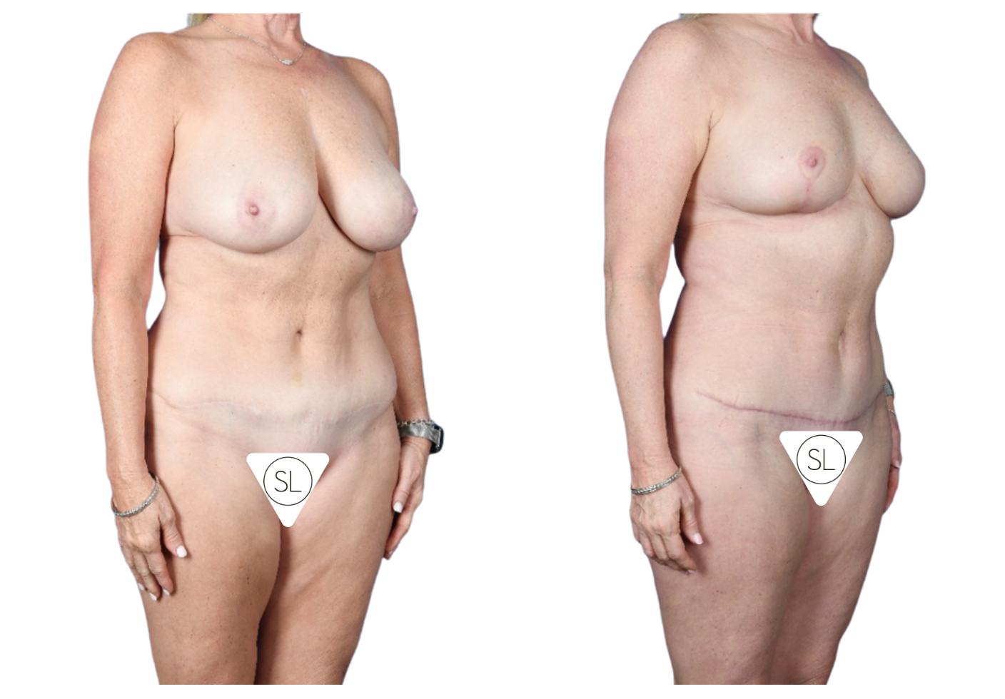 Before and After Image: Breast Reduction, Axillary Liposuction, Mini Tummy Tuck - right-front-oblique