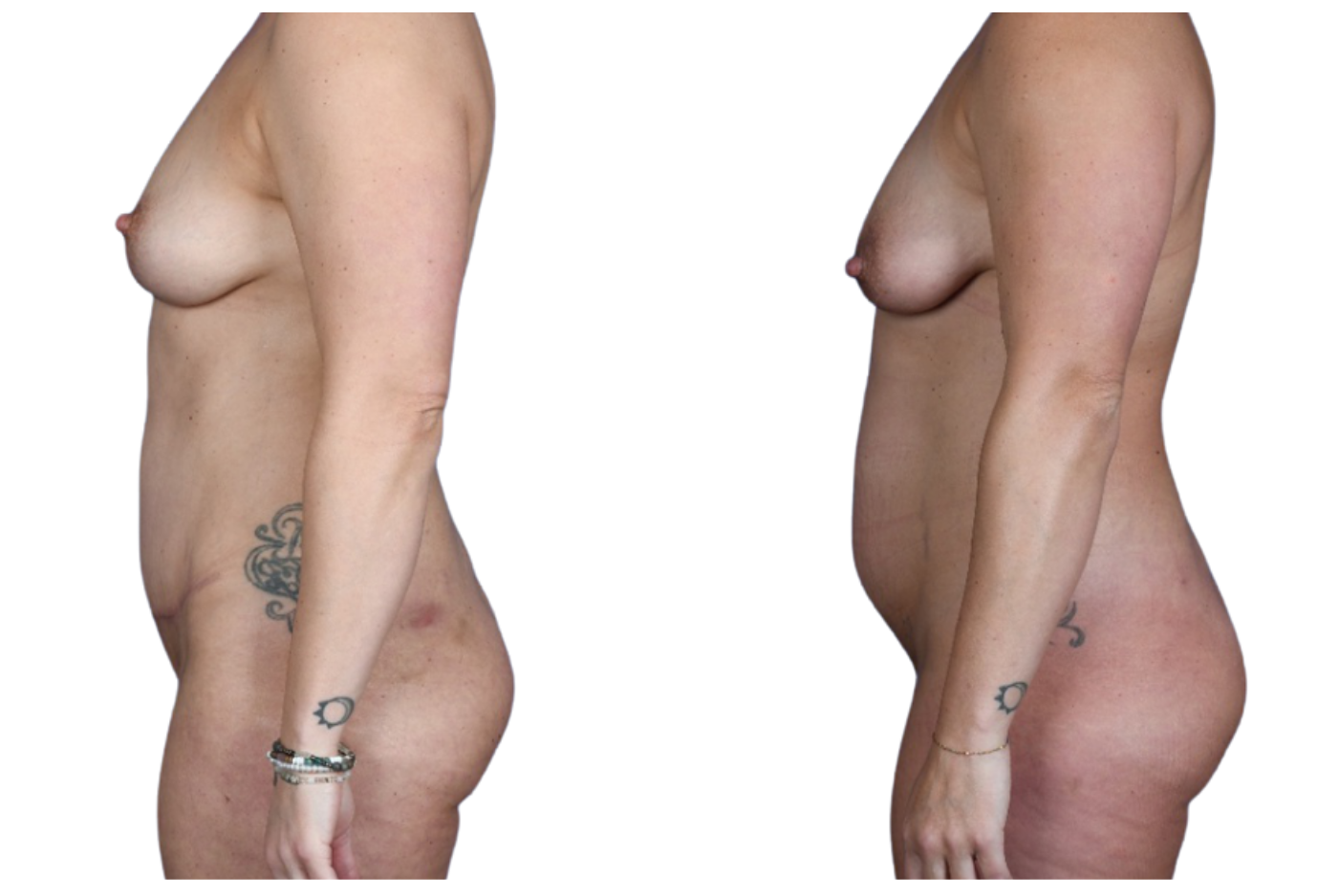 Before and After Image: Breast Fat Grafting, Abdominoplasty, Liposuction Flanks - left-side