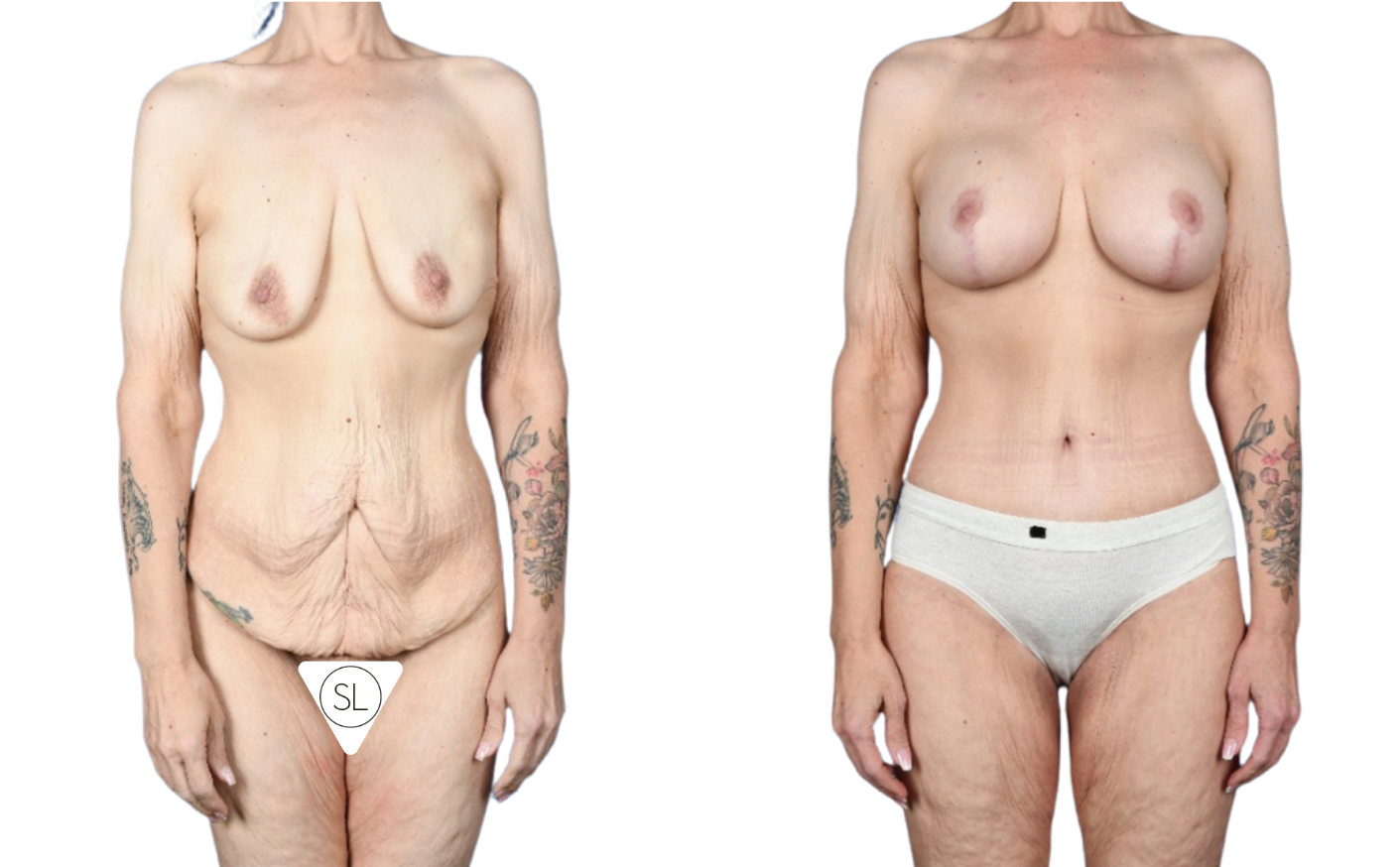 Before and After Image: Abdominoplasty, Mastopexy, Breast Augmentation, Mesh Implant Support - front