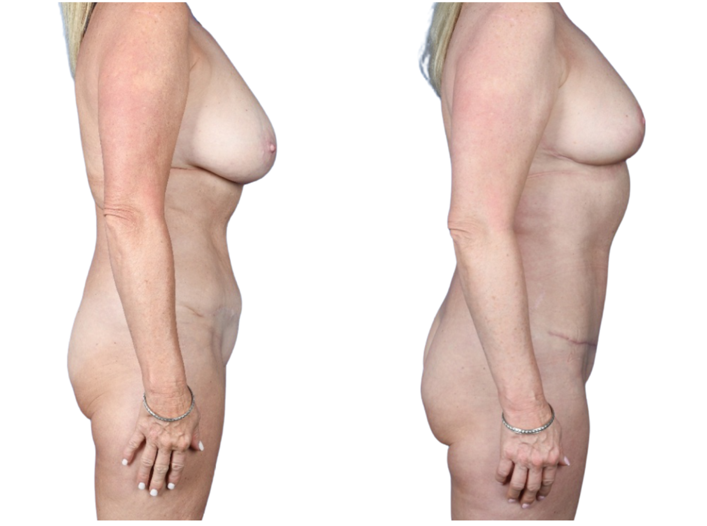 Before and After Image: Breast Reduction, Axillary Liposuction, Mini Tummy Tuck - right-side