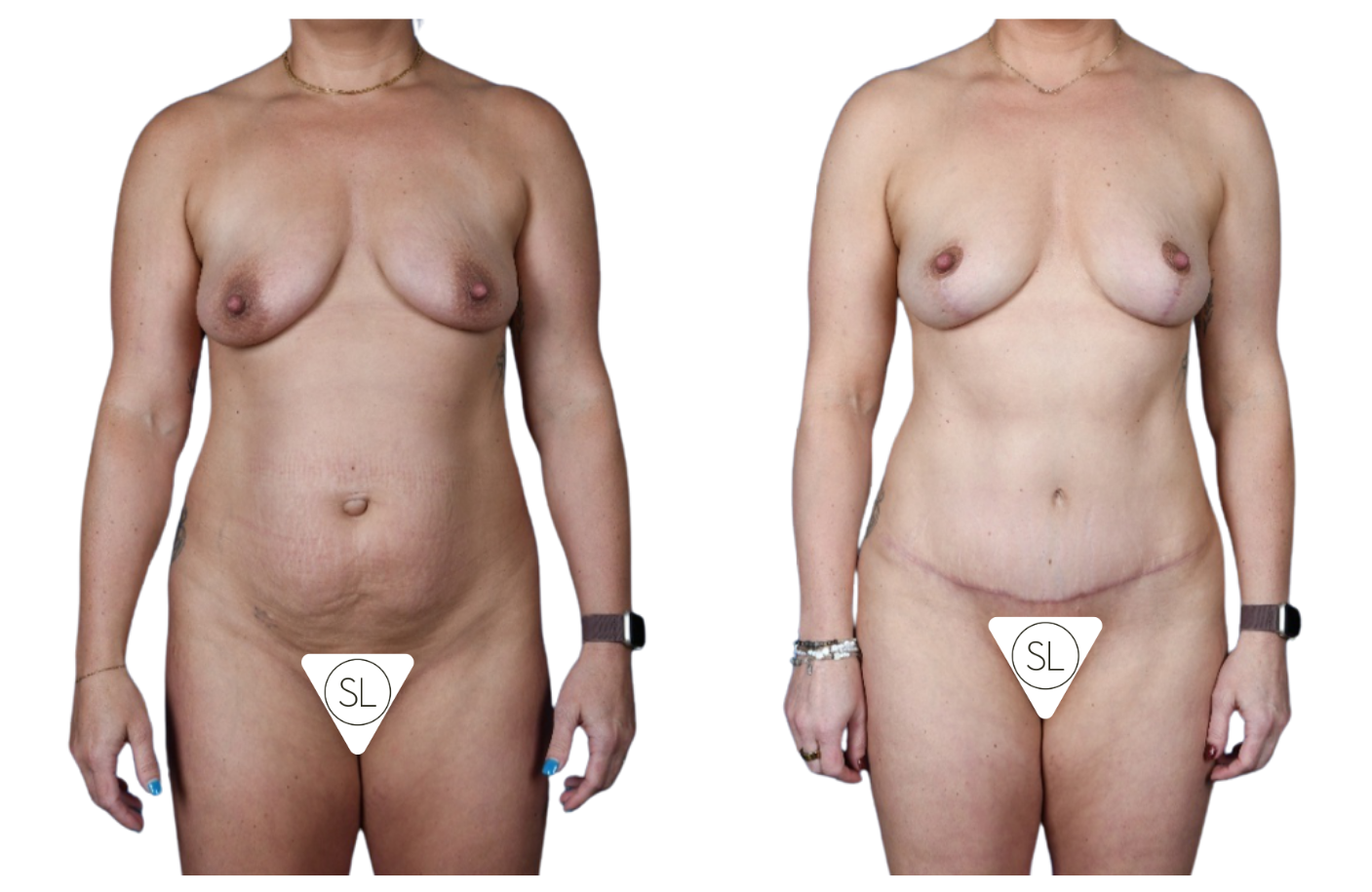 Before and After Image: Breast Fat Grafting, Abdominoplasty, Liposuction Flanks - front