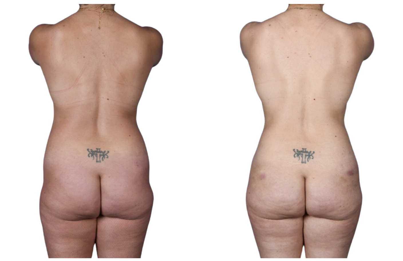 Before and After Image: Breast Fat Grafting, Abdominoplasty, Liposuction Flanks - back