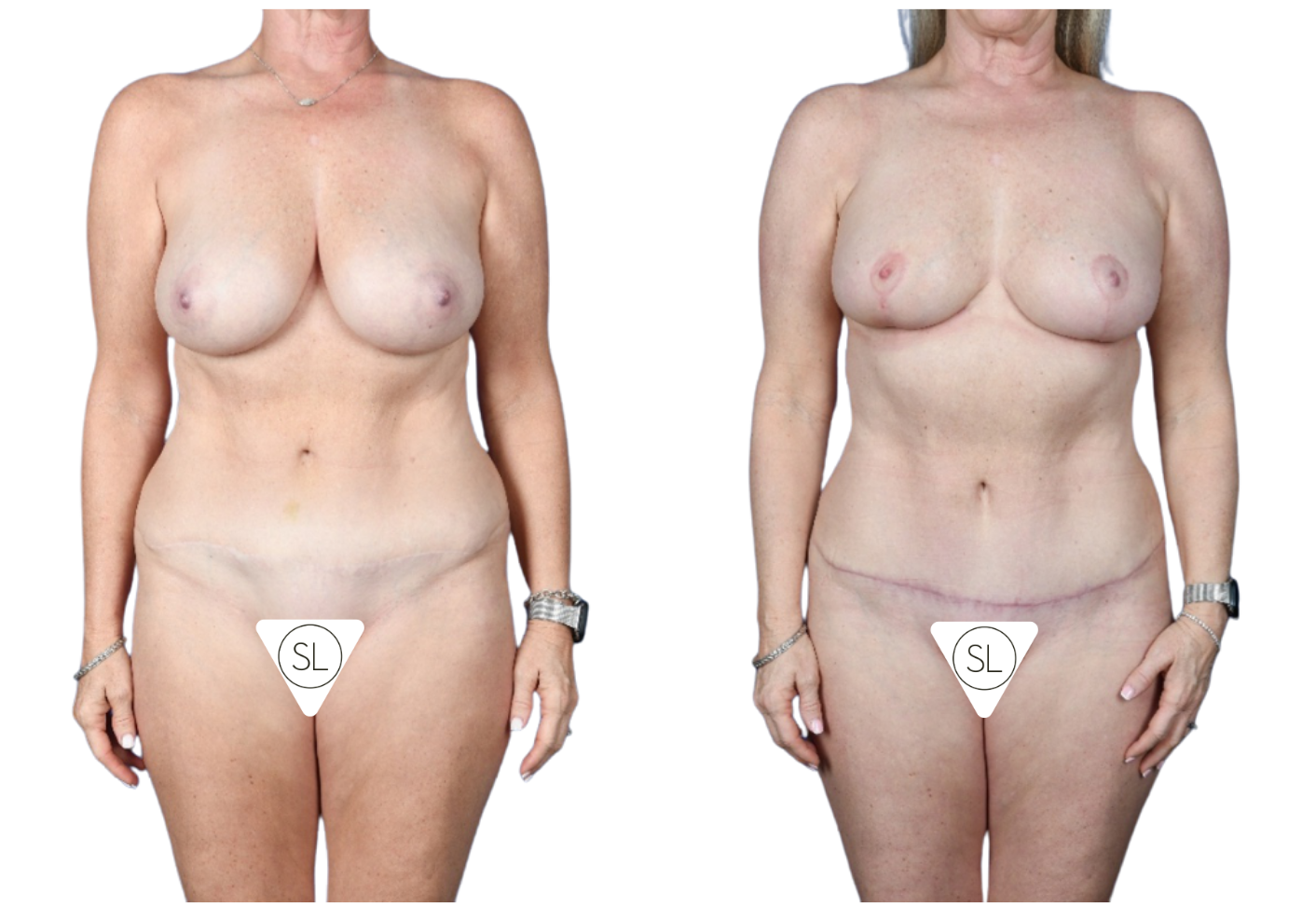 Before and After Image: Breast Reduction, Axillary Liposuction, Mini Tummy Tuck - front