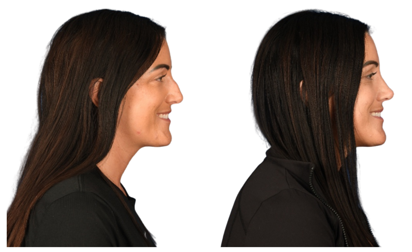 Before and After Image: Rhinoplasty - right-side
