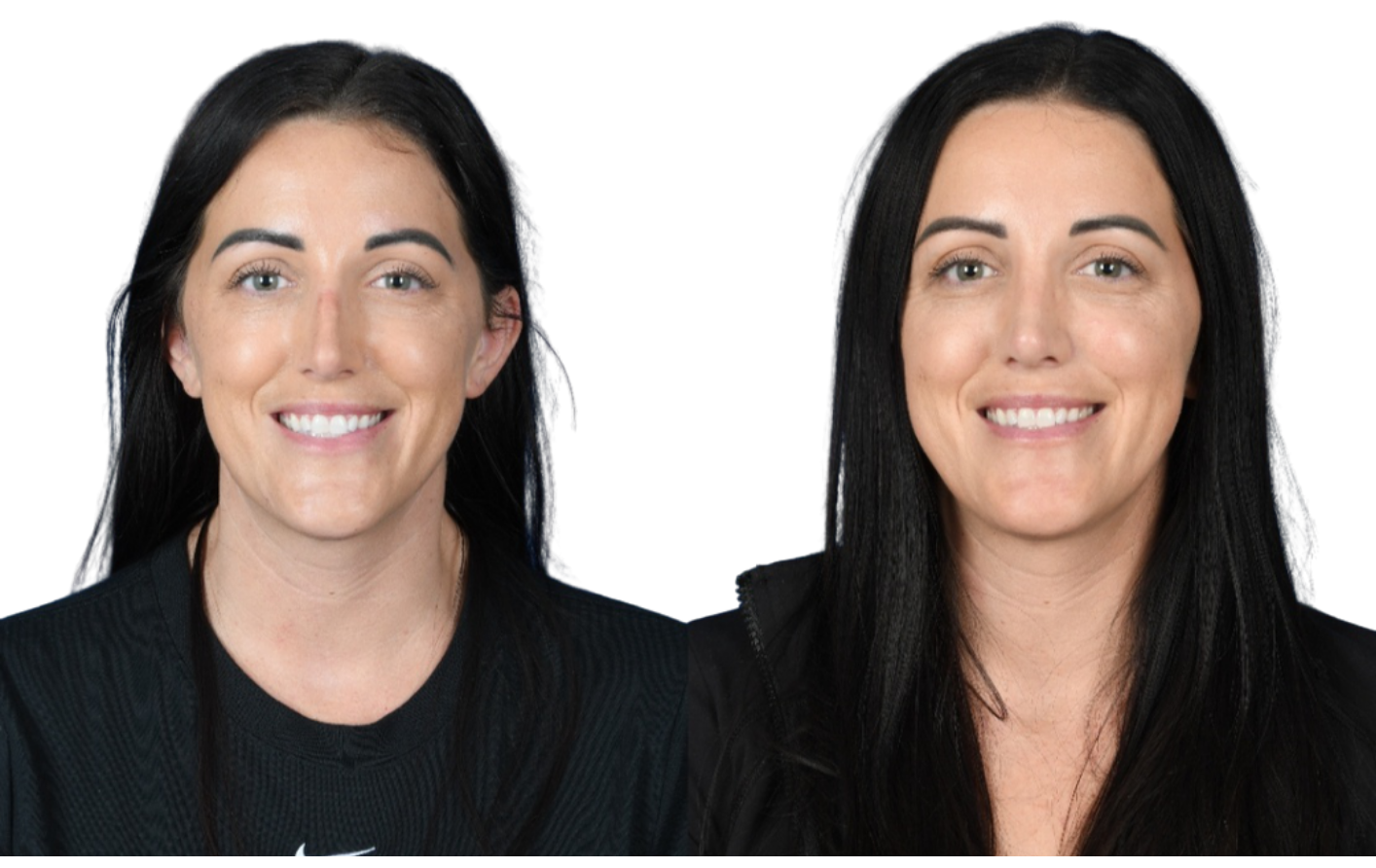 Before and After Image: Rhinoplasty - front