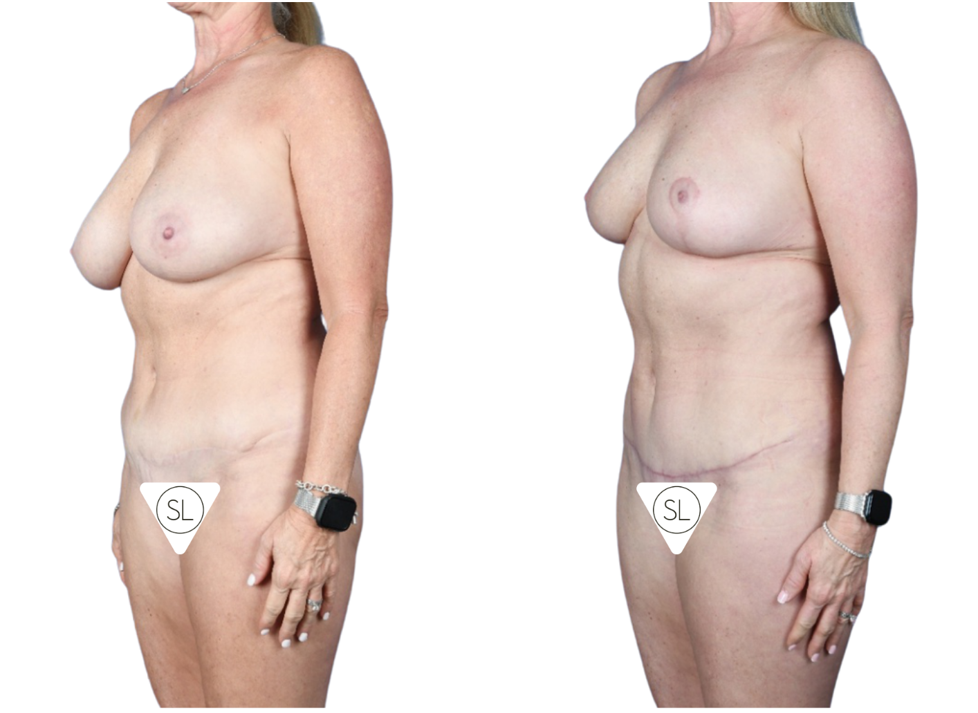 Before and After Image: Breast Reduction, Axillary Liposuction, Mini Tummy Tuck - left-front-oblique