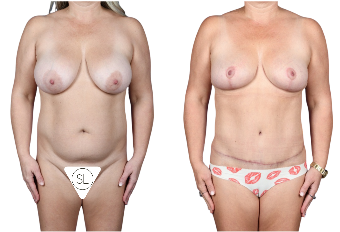 Before and After Image: Breast Reduction, Standard Abdominoplasty (Lipo 360), Liposuction Upper Back/Lat Chest wall - front