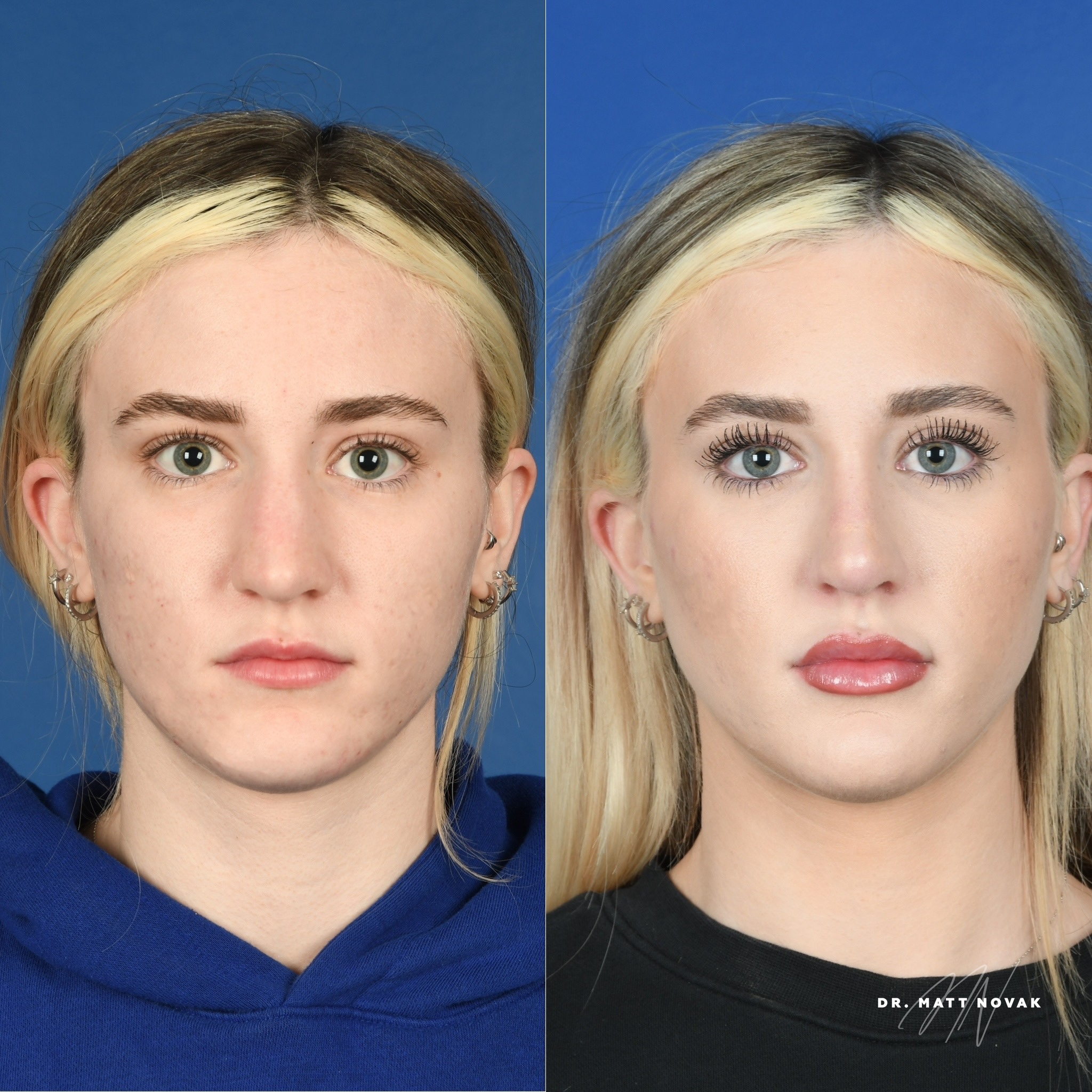 Before and After Image: Rhinoplasty - front
