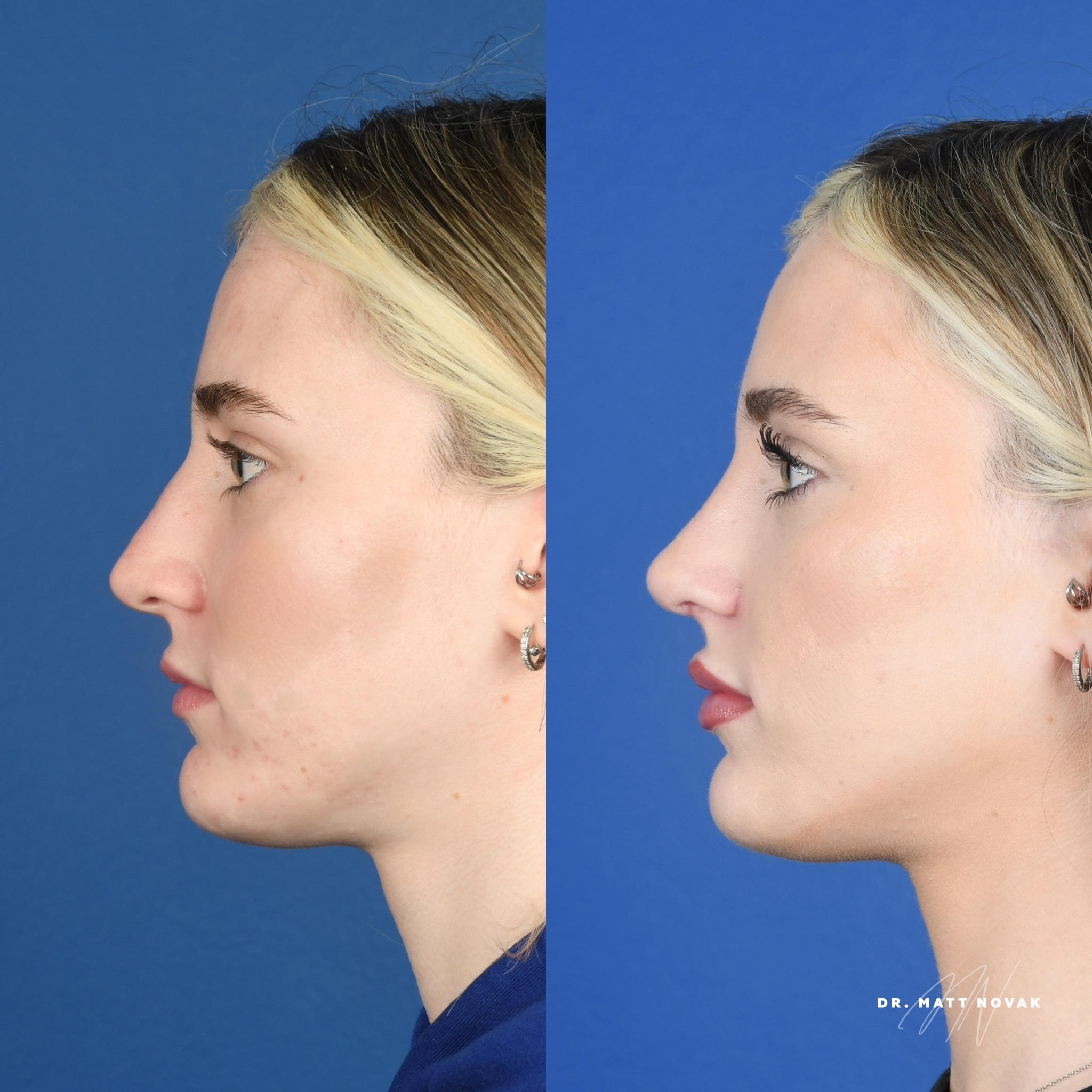 Before and After Image: Rhinoplasty - left-side
