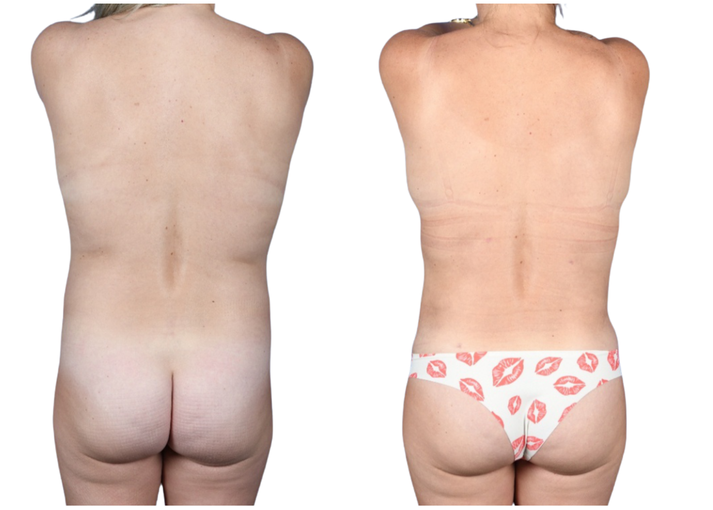 Before and After Image: Breast Reduction, Standard Abdominoplasty (Lipo 360), Liposuction Upper Back/Lat Chest wall - back