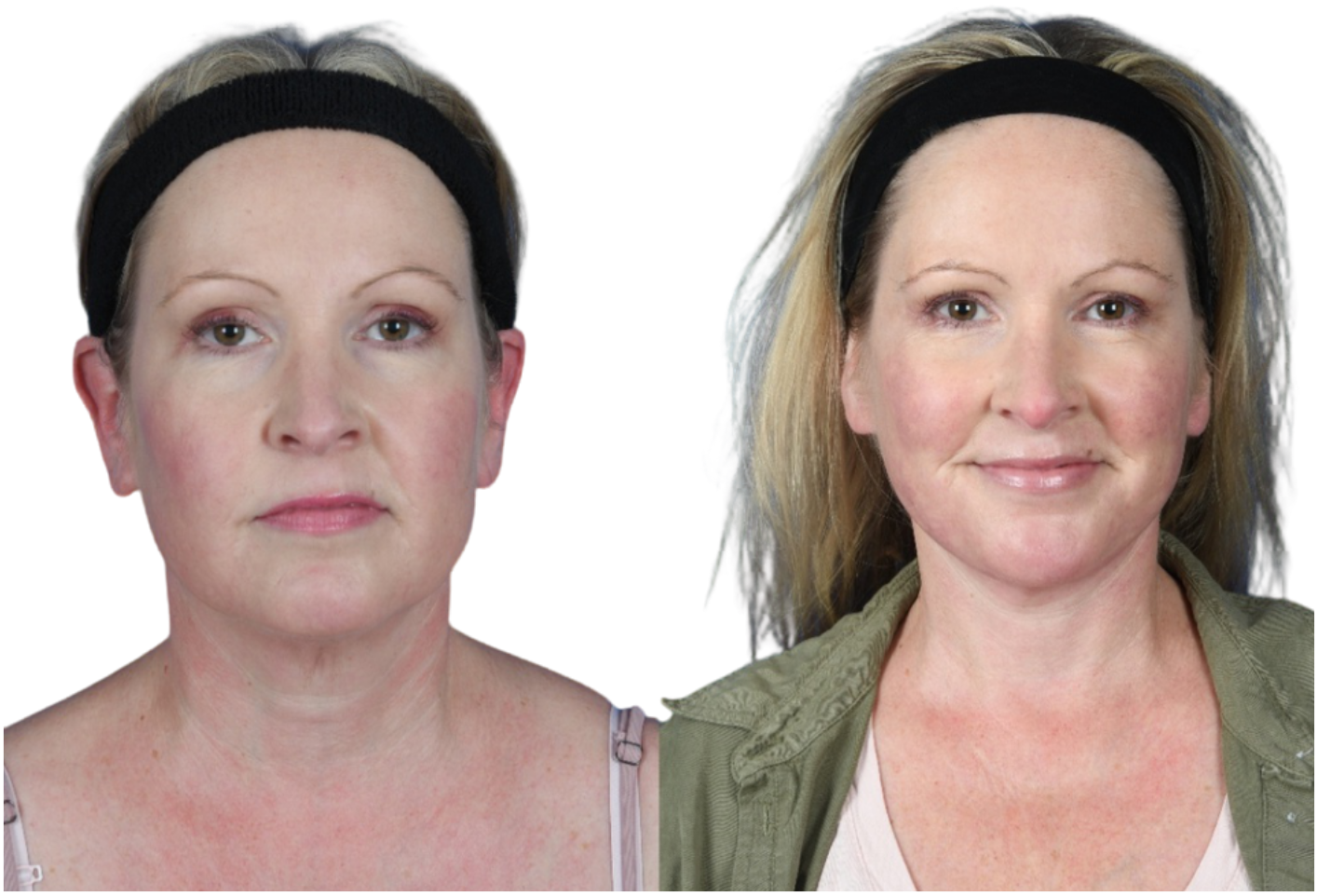 Before and After Image: Neck Lift - front