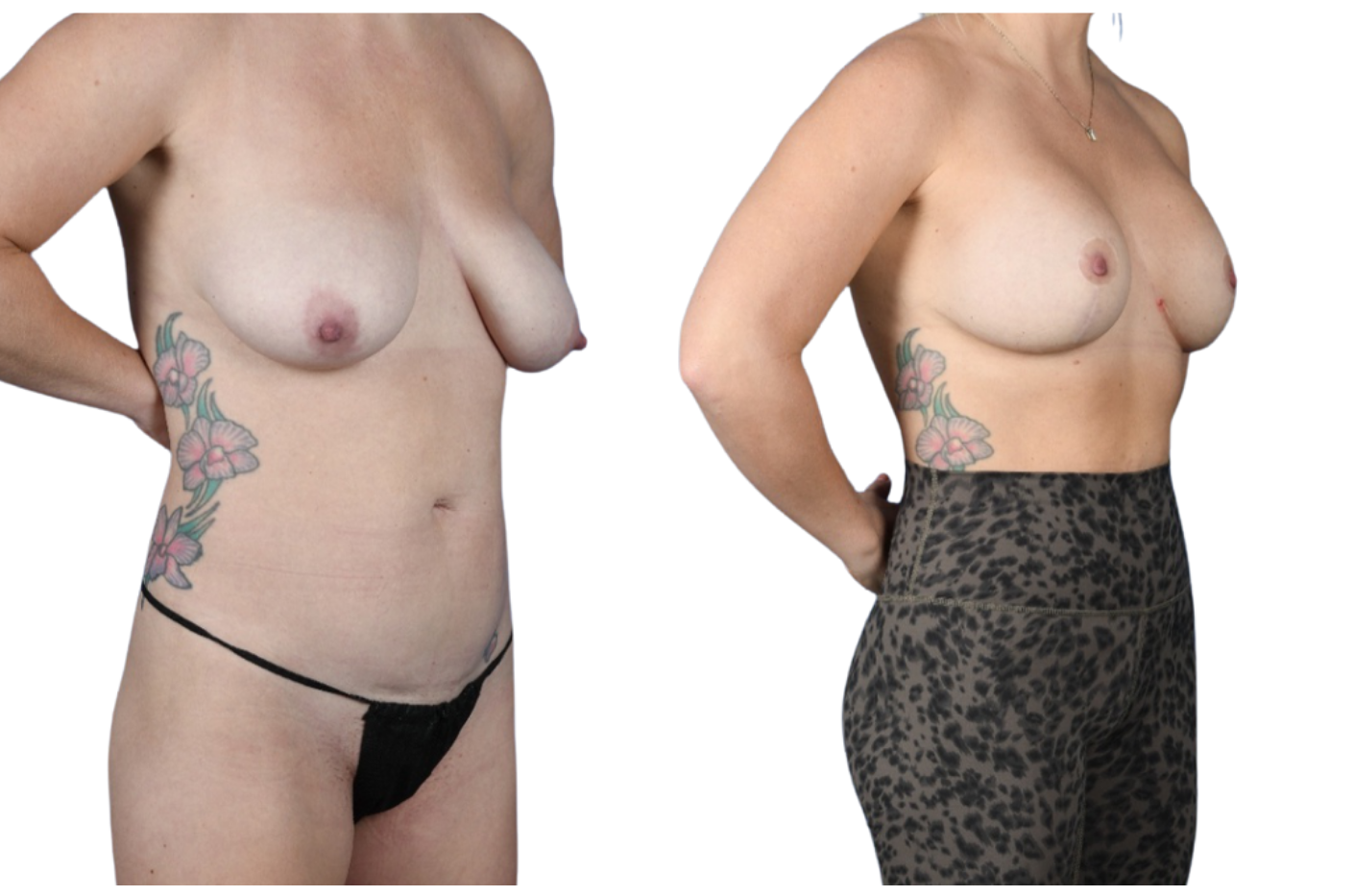 Before and After Image: Breast Augmentation, Mastopexy - right-front-oblique