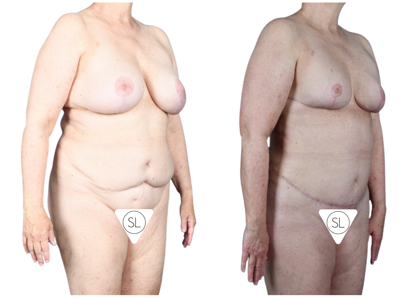 Before and After Image: Extended Breast Reduction, Liposuction 360, Mini Tummy Tuck - right-front-oblique