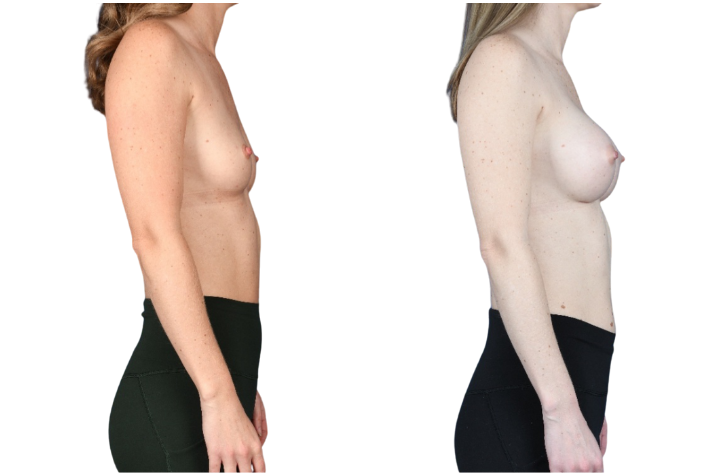 Before and After Image: Breast Augmentation - right-side