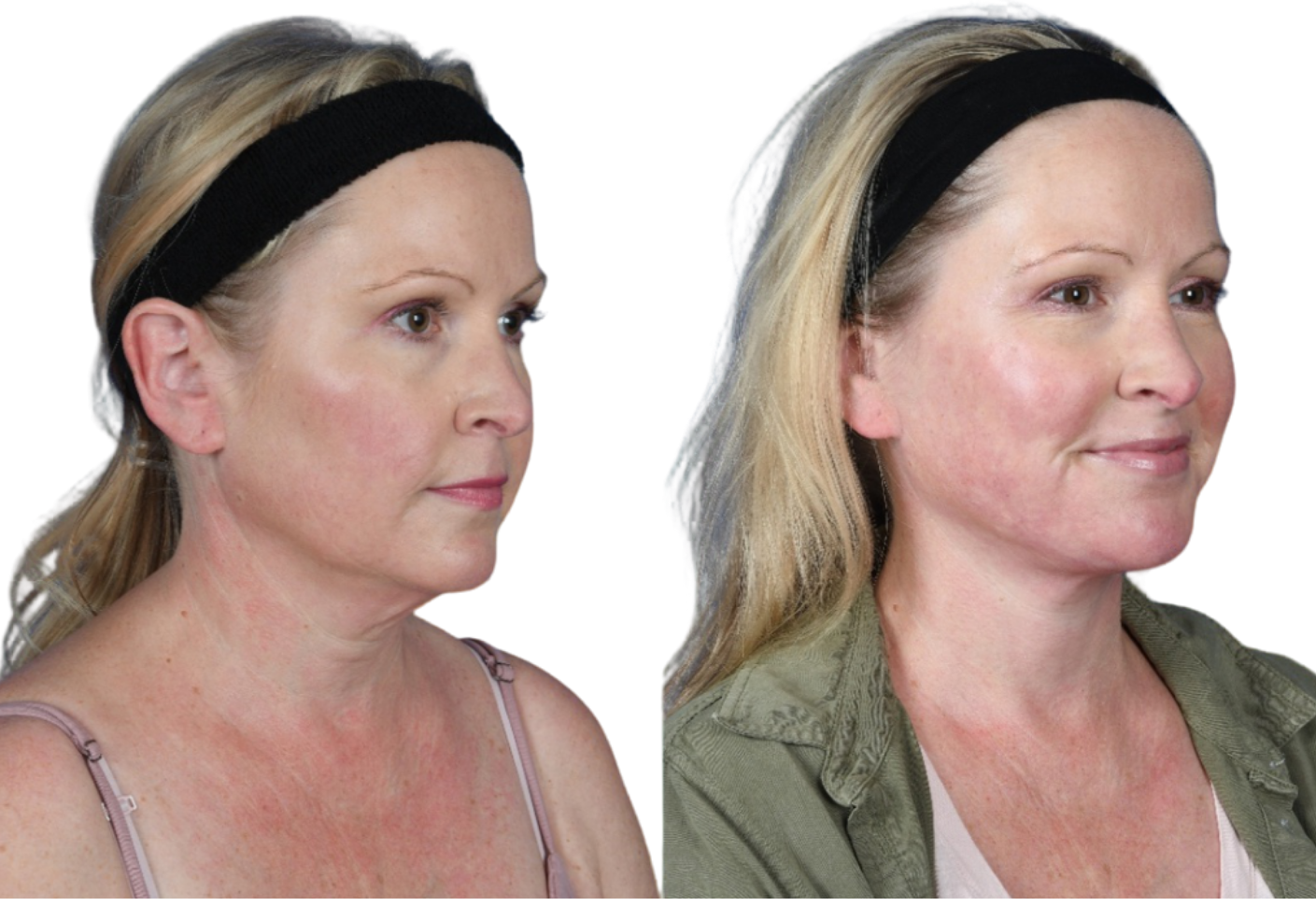 Before and After Image: Neck Lift - right-front-oblique