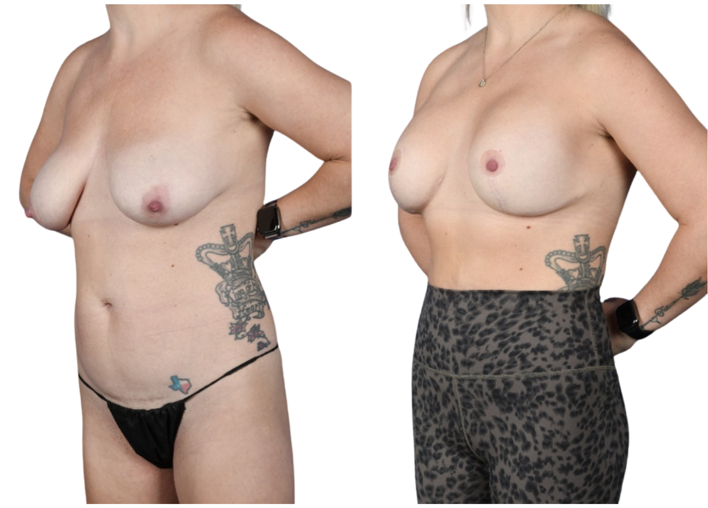 Before and After Image: Breast Augmentation, Mastopexy - left-front-oblique