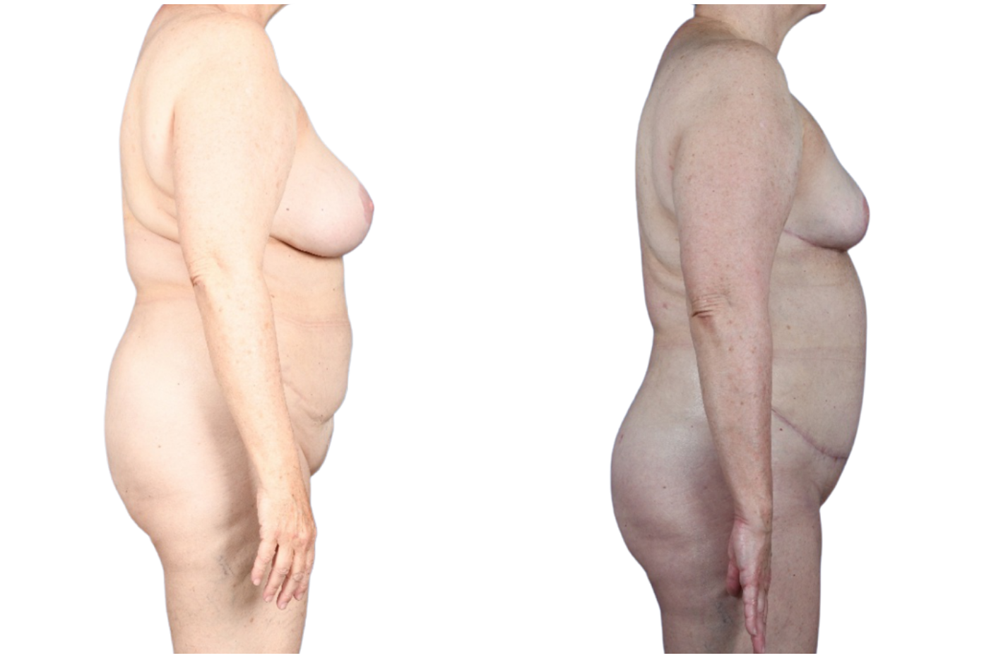 Before and After Image: Extended Breast Reduction, Liposuction 360, Mini Tummy Tuck - right-side
