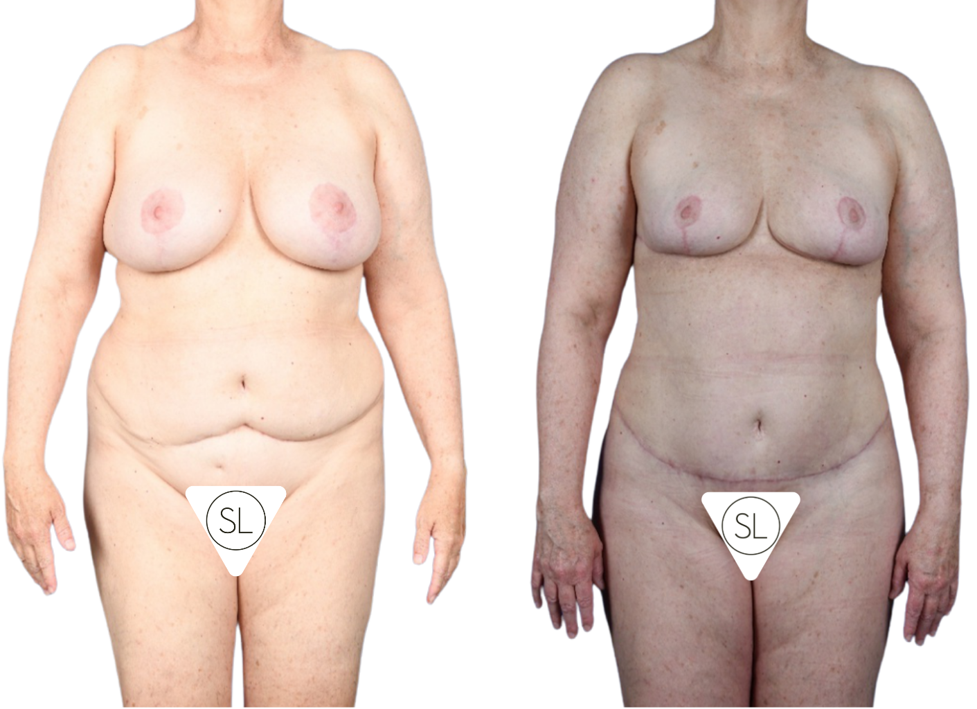Before and After Image: Extended Breast Reduction, Liposuction 360, Mini Tummy Tuck - front