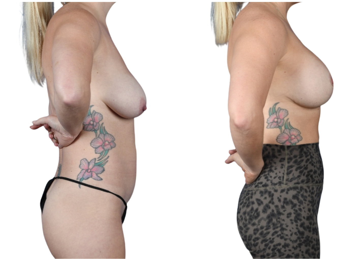Before and After Image: Breast Augmentation, Mastopexy - right-side