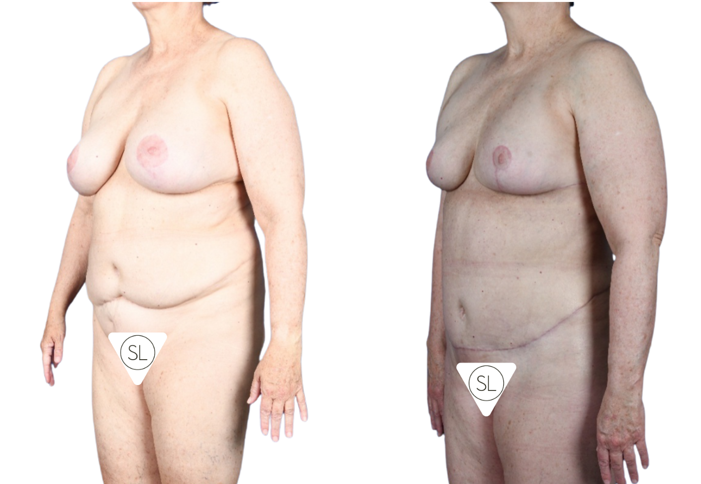 Before and After Image: Extended Breast Reduction, Liposuction 360, Mini Tummy Tuck - left-front-oblique