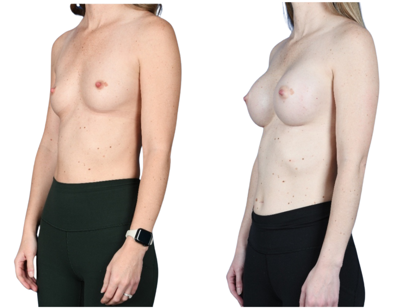 Before and After Image: Breast Augmentation - left-front-oblique