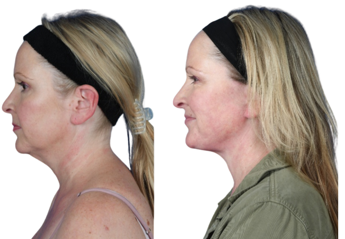Before and After Image: Neck Lift - left-side